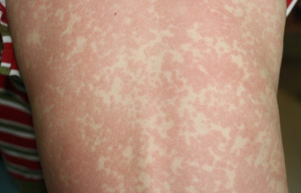 Casos de sarampo vem fazendo vítimas em todo o mundo: entenda o motivo