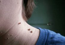 3 receitas caseiras para acabar com as verrugas