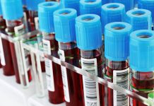 Teste de sangue pode substituir a mamografia