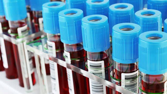 Teste de sangue pode substituir a mamografia