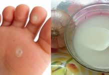 Conheça o remédio mais eficaz para os calos dos pés: cebola e vinagre branco