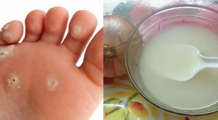 Conheça o remédio mais eficaz para os calos dos pés: cebola e vinagre branco