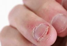 Onicofagia: Compulsão em roer unhas é sinal de alerta