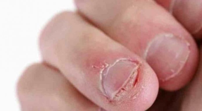 Onicofagia: Compulsão em roer unhas é sinal de alerta