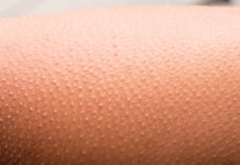 Saiba o que são as espinhas que aparecem no braço e como tratar