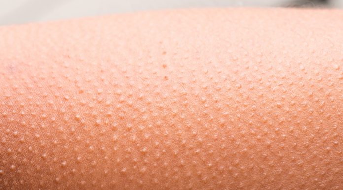 Saiba o que são as espinhas que aparecem no braço e como tratar