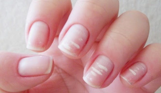 Manchas brancas nas unhas: O que são?