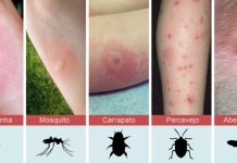 Você não sabe que inseto lhe Picou? Então descubra as  8 picadas mais comuns.