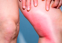 Trombose: alerta, causas, tratamentos. previna-se.