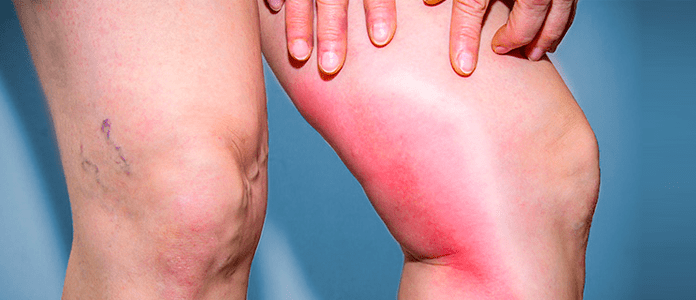 Trombose: alerta, causas, tratamentos. previna-se.