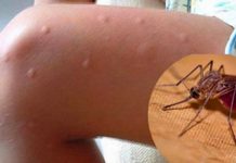 Sete razões para torná-lo mais propenso a picadas de mosquitos.