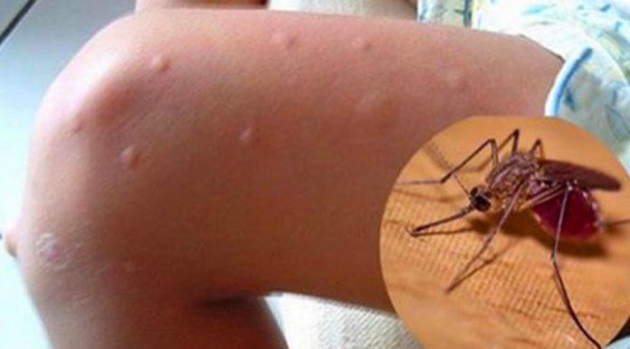 Sete razões para torná-lo mais propenso a picadas de mosquitos.