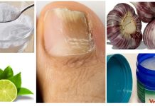 Remédios caseiros e naturais para fungo na unha.