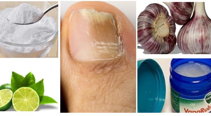Remédios caseiros e naturais para fungo na unha.