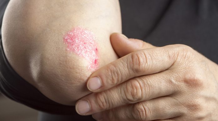 10 verdades sobre a psoríase que você precisa saber