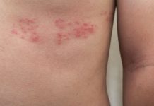 Quem tem mais 50 anos deve saber tudo sobre herpes-zóster