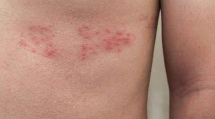 Quem tem mais 50 anos deve saber tudo sobre herpes-zóster