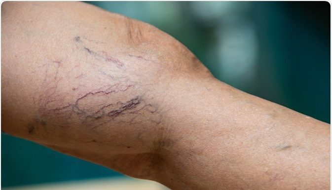 Como reduzir naturalmente as veias da aranha (varicosas).