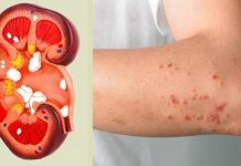 8 sinais inconfundíveis de que seus rins estão com problemas.