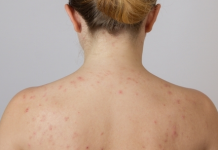 Diga-me onde você tem acne e direi o que está doente em você.