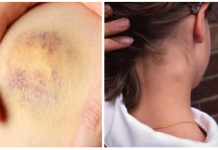 7 sinais importantes de leucemia que você não deve ignorar.