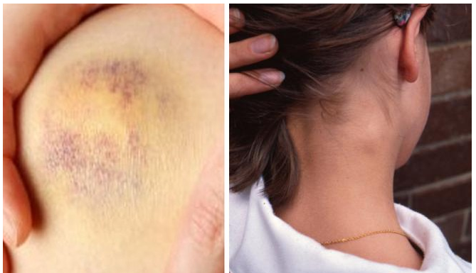 7 sinais importantes de leucemia que você não deve ignorar.