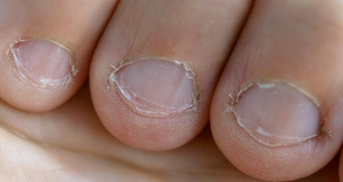 Veja por que as pessoas costumam roer as unhas e maneiras fáceis de parar