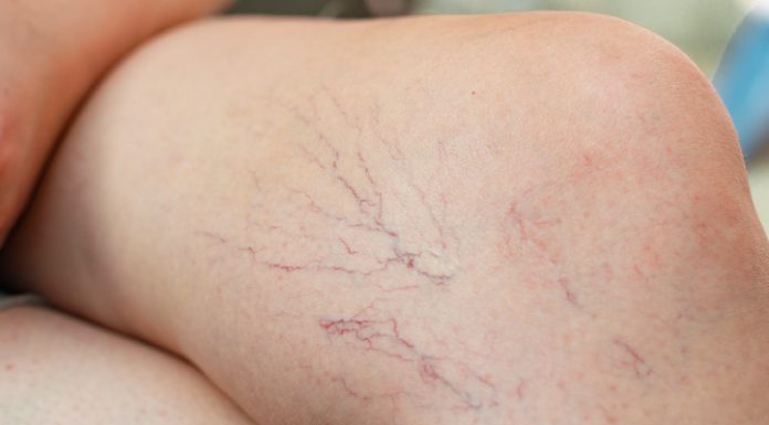 Exercícios recomendados para prevenir varizes