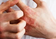 Eczema: A irritação nas mãos não é apenas pele seca?