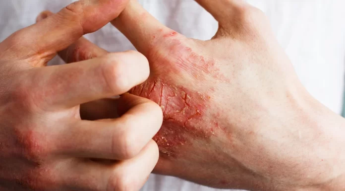 Eczema: A irritação nas mãos não é apenas pele seca?
