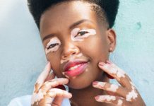 Vitiligo: o que exatamente é e como se manifesta?