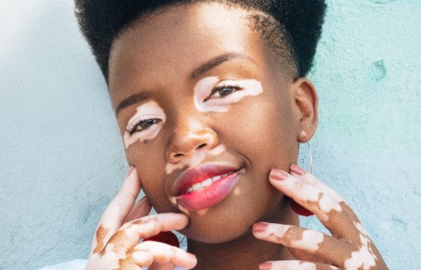 Vitiligo: o que exatamente é e como se manifesta?