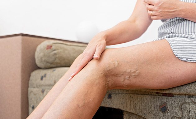 Trombose: Quais são os sintomas e causas de sua ocorrência