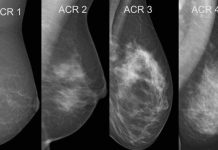 Exame de tomossíntese se mostra o mais eficiente para diagnosticar câncer de mama